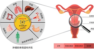 全癌标志物可以将宫颈癌的筛查提前到高级别瘤变阶段