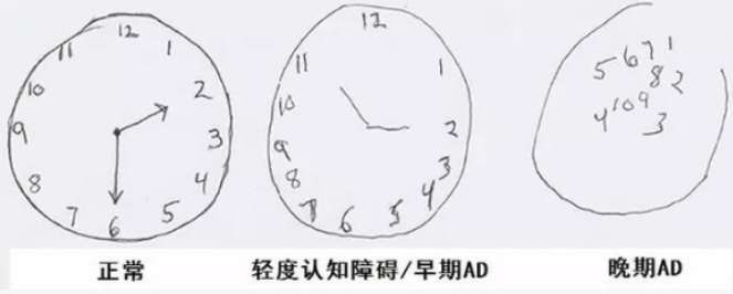 阿尔茨海默症等病早期标志物确定 为潜在免疫疗法提供新线索