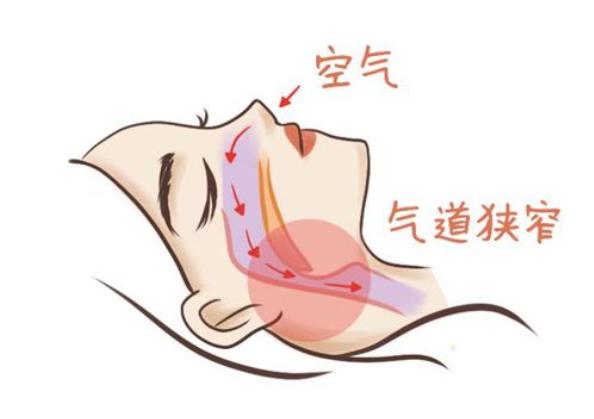 打呼噜可能增加罹患肿瘤风险 中重度OSA患者更高患癌风险